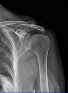 shoulder x ray