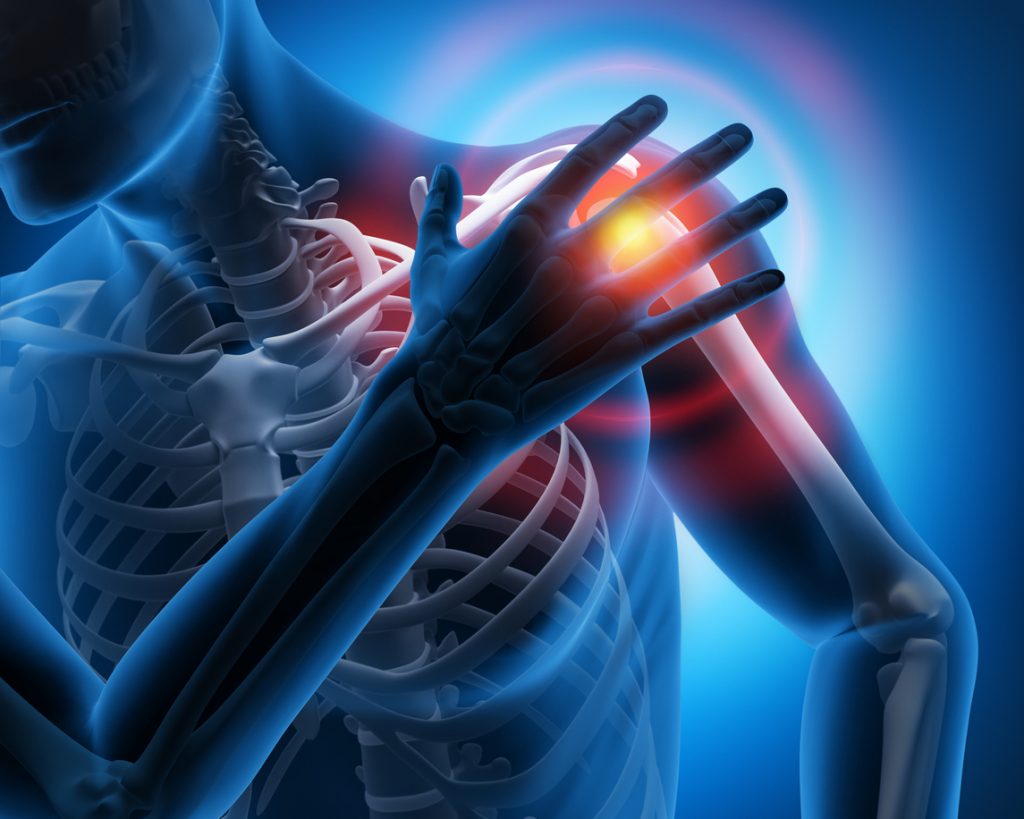 What to Know About Shoulder Impingement